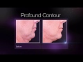 Profound Non-Surgical Facelift Michigan Plastic Surgeon Dr. Michelle Hardaway