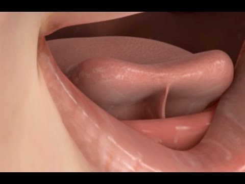 Video: Wanneer word ankyloglossia diagnose?