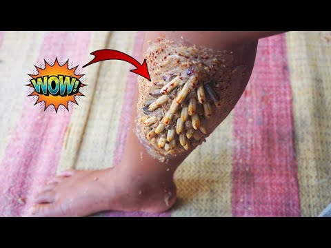 [ Worms Body ] How to Remove Worms On Dandruff #347