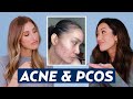 Hormonal Acne & Polycystic Ovary Syndrome (PCOS) Skincare Routine for Lala | DERMATOLOGIST REACTS