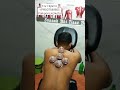 Hijama Cupping Therapy in Kolkata