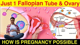 Feasibility of Conceiving with a Single Fallopian Tube and An Ovary