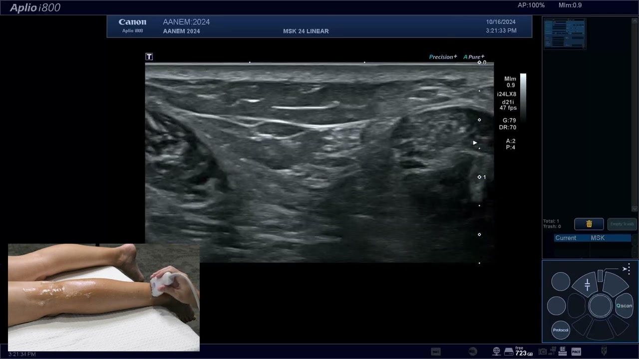 Ультразвуковая оценка икроножного нерва