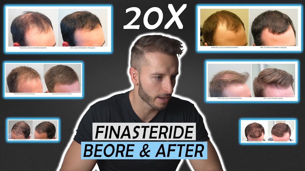 20 Finasteride Before And After Results! NW1 - NW5/NW6