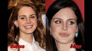 Lana Del Rey Plastic Surgery: Before and After Lip Implants and Nose Job