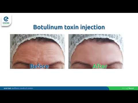 Botox - Botulinum Toxin Injection - Everlast Wellness Medical Center - Abu Dhabi