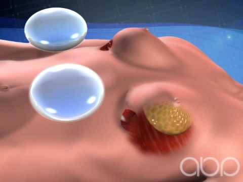 Breast Implant Surgery - 3D Medical Animation || ABP ©