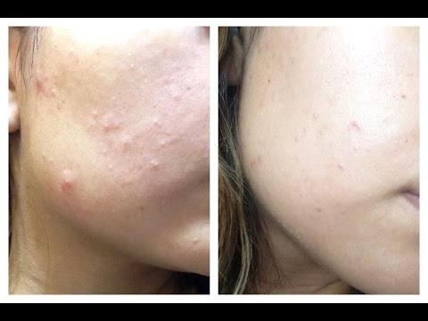 Como Eliminar el Acne en tu rostro en una semana | Tratamiento contra granitos | Acne Hormonal