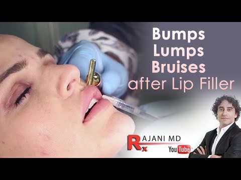 Video: Swelling After Lip Augmentation With Hyaluronic Acid: How Long Does It Last And How To Remove It