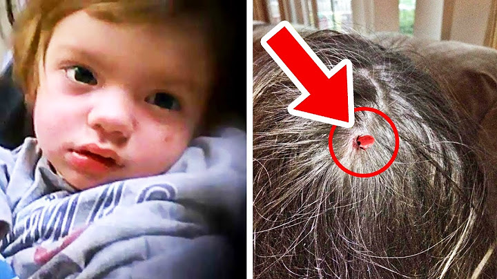3 letý chlapec náhle ochrnul, pak se mu matka podívala do vlasů a našla něco šokujícího…