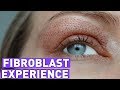 FIBROBLAST treatment experience/ before and after 7 days