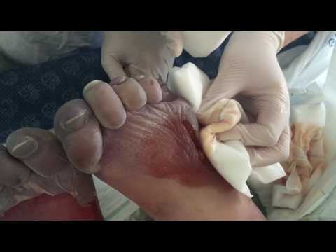Frost bitten feet blisters draining and droofing draining 2