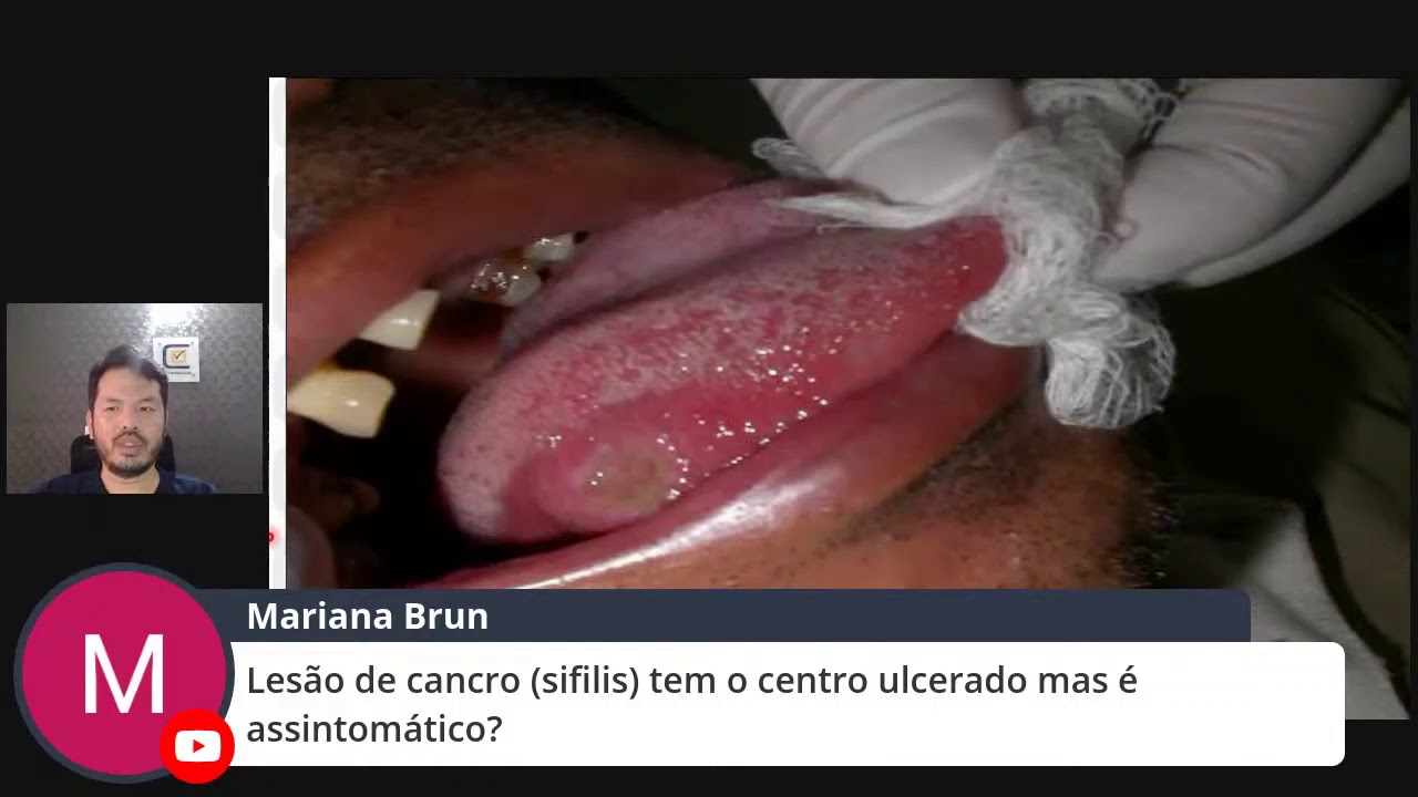Lesão de Cancro (Sifilis)- CD Concursos - YouTube