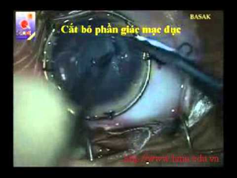 M 08  Phẫu thuật ghép giác mạc xuyên