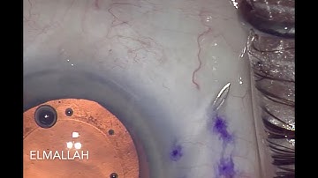 XEN Stent My Preferred Technique