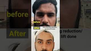 facial feminisation / brow bossing india delhi mumbai kolkata chennai bangalore hyderabad ahmedabad