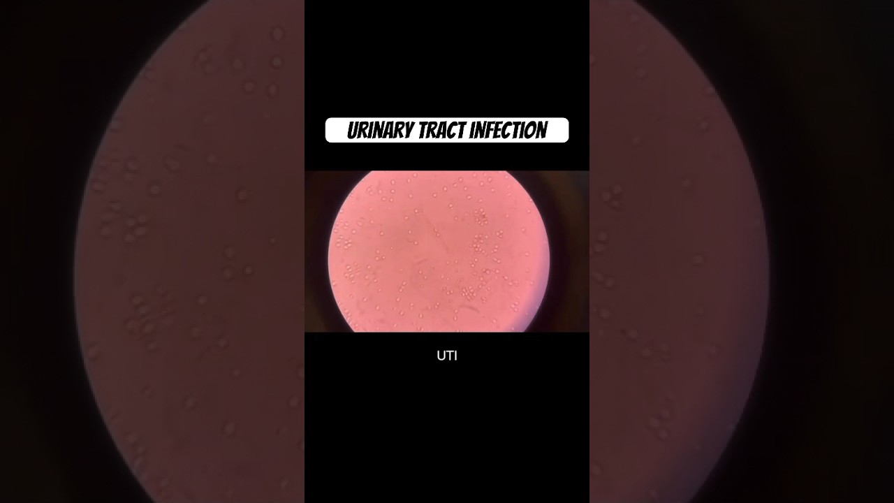 Urinary tract infection -pathology slides 