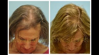 Dallas MTF Transgender Hair Transplant Front to Back 1 Year Out Testimonial + Photos