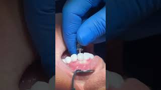 zirconia crown screw retained over implant #dentist #satisfying