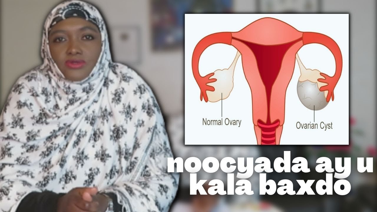 NUUCYADA BURO - BIYOODKA & CALAAMADAHA LAGU GARTO?!