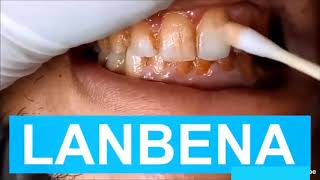 Lanbena Whitening Teeth
