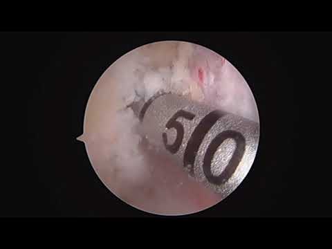 Anterior Medial Portal ACL Reconstruction Surgical Technique Video