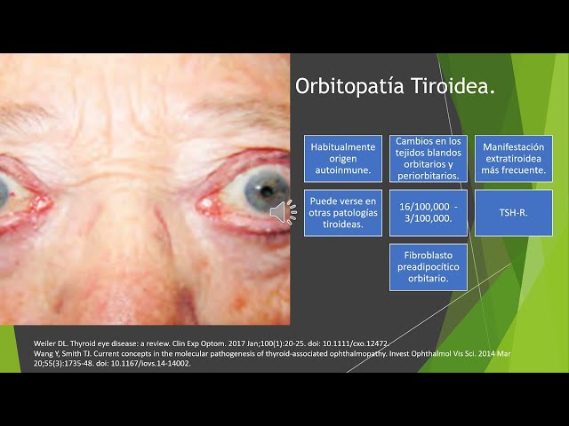 Orbitopatía tiroidea y su influencia en el manejo del paciente con glaucoma