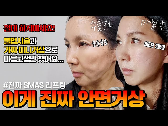 이게 진짜 안면거상이지!  불법시술과 가짜미니거상 절대 하지마세요!! #안면거상 #성형정보 #불법시술 #가짜안면거상