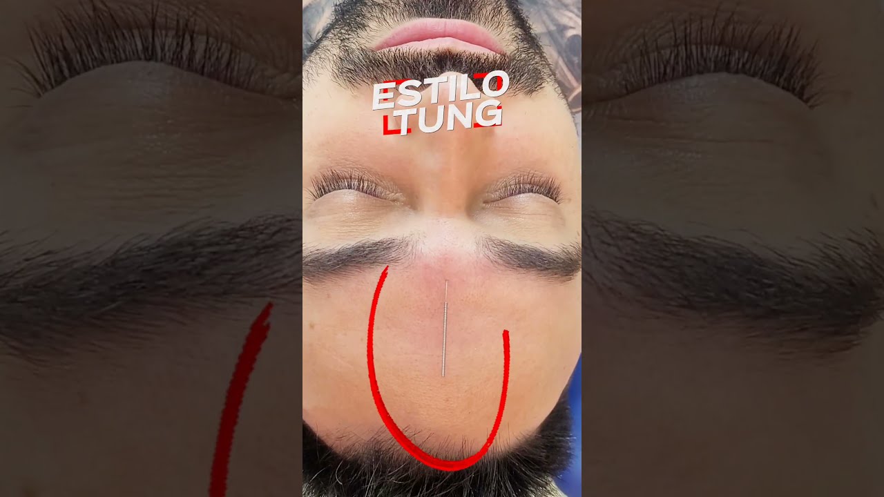 ACUPUNTURA para la ANSIEDAD/ESTRÉS