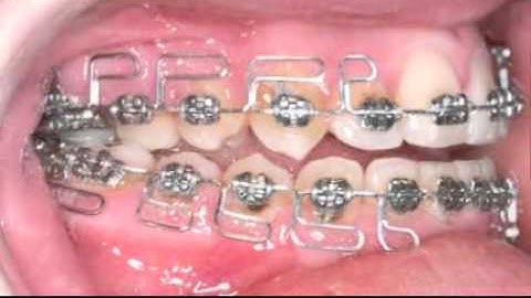 Class III open bite.mpeg