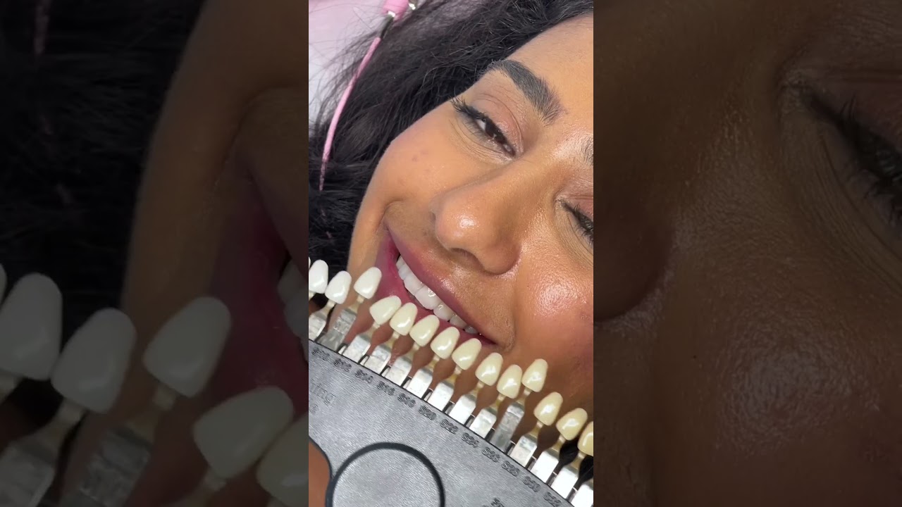 Процесс отбеливания зубов 🦷 