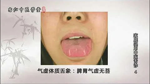 罗大伦 家庭实用中医舌诊 第4讲 罗大伦《家庭实用中医舌诊》气虚湿气重的舌象 罗博士图解舌诊 简繁中文字幕 - 天天要闻