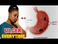 How to overcome peptic ulcer