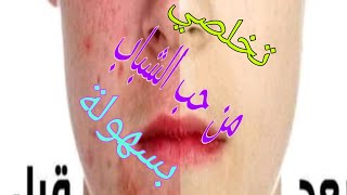 وصفة حب الشباب السحرية