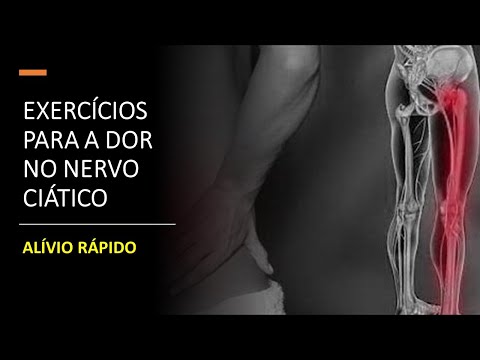 Exercícios para a Dor no Nervo Ciático
