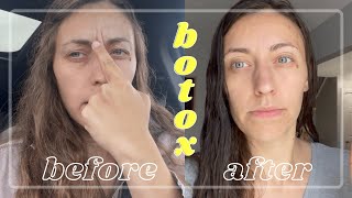 My Botox Experience! Days 16