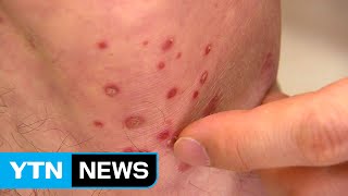 가을철 온 몸 '근질 근질'...심하면 우울증 유발 / YTN (Yes! Top News)