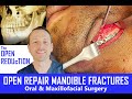 In the or broken jaw surgery  mandible fracture  repair