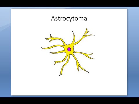 Video: Astrocytom Mozku: Léčba, Prognóza, Formy