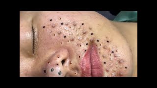 Relax Blackheads Removal every day 538 blackhead blackheadremoval acnetreatment