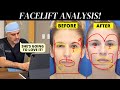 Facial plastic surgeon analyzes his 63 year old patients face