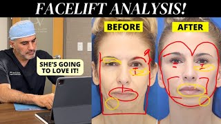 Facial Plastic Surgeon Analyzes his 63 year old patient