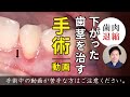 札幌市の歯医者「ユアーズデンタル クリニック」下がった歯茎の治療！（右上トンネルテクニック）