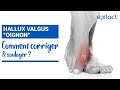 Tuto  hallux valgus  comment corriger  soulager   epitact mdical
