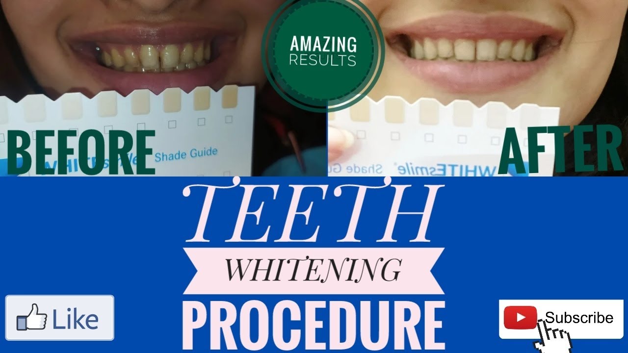Steps of teeth whitening Bleaching dentistry viralvideos fyp 