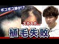 【植毛失敗】提供していただいた自毛植毛の失敗例をご紹介