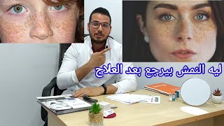 النمش ليه بيرجع بعد العلاج؟؟؟ افضل وارخص علاج موضعي