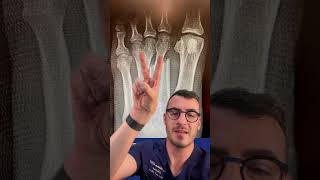 Metatarsal Fractures