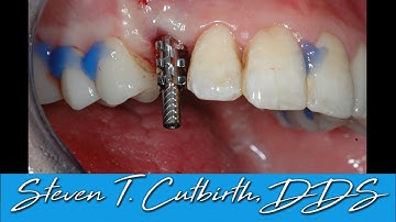 Anterior Implant & Crown - Uncovering & Impressing Implant