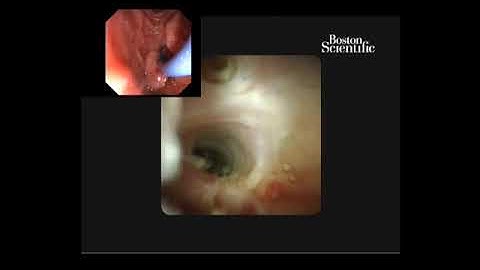 cholangioscopy